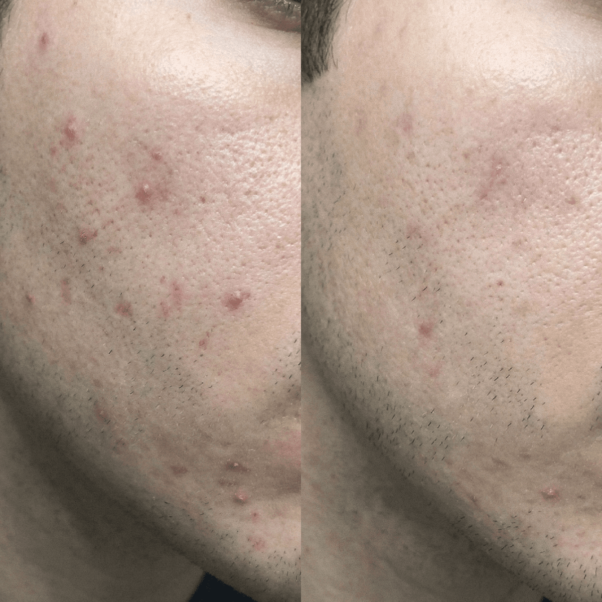 Blemish Purity CBD-Creme für unreine Haut